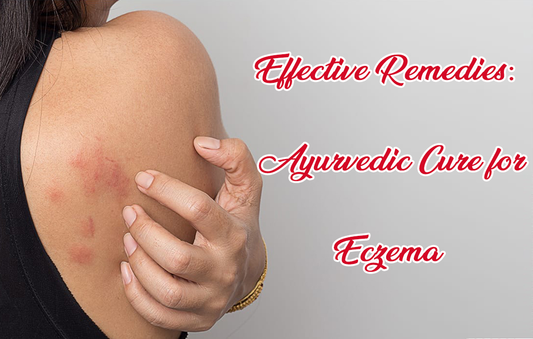 ayurvedic cure for eczema