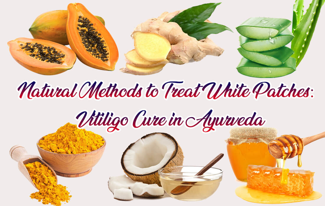 vitiligo cure in ayurveda