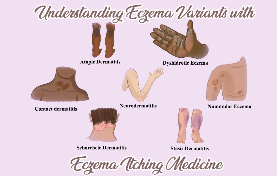 eczema itching medicine